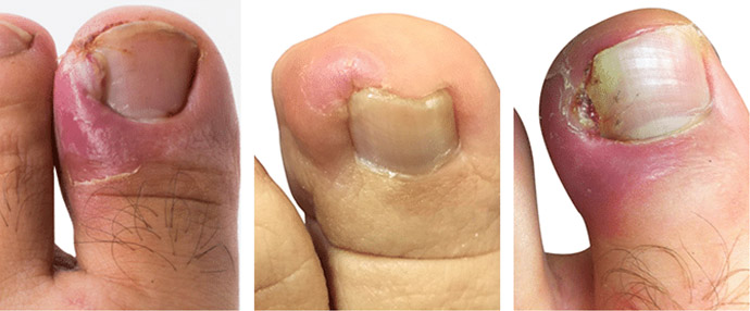ingrown-toenail-nail-examples-surgery-podiatry-services-podiatry-care-gawler-barossa