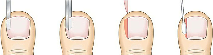 ingrown-toenail-nail-surgery-process-podiatry-services-podiatry-care-gawler-barossa